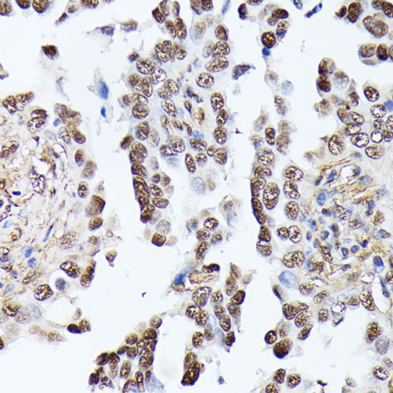 Immunohistochemistry of paraffin-embedded Human lung cancer using TPI1 Polyclonal Antibody at dilution of  1:100 (40x lens).