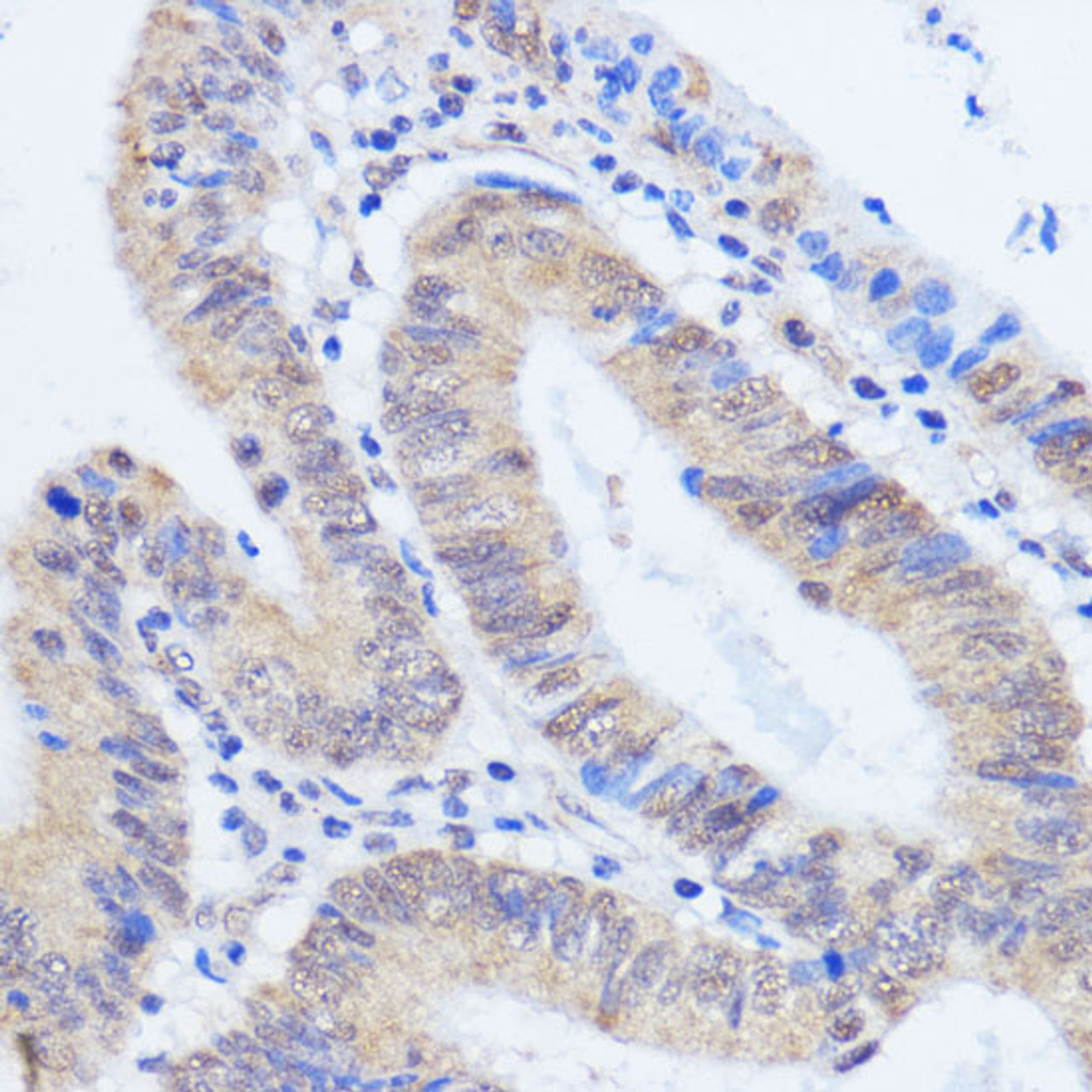 Immunohistochemistry of paraffin-embedded Human colon carcinoma using RBM39 Polyclonal Antibody at dilution of  1:100 (40x lens).