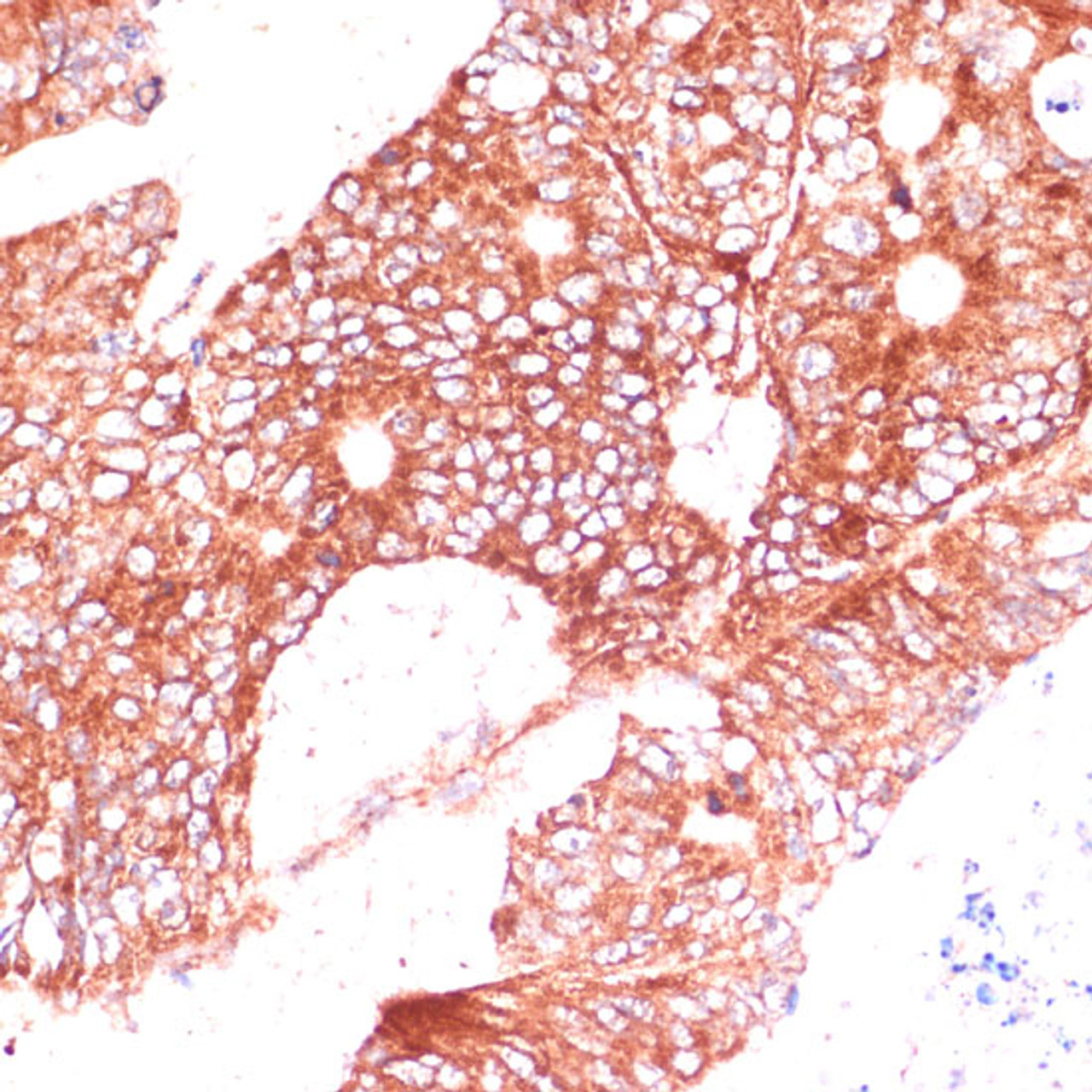 Immunohistochemistry of paraffin-embedded Human colon carcinoma using FAM98A Polyclonal Antibody at dilution of  1:100 (40x lens).