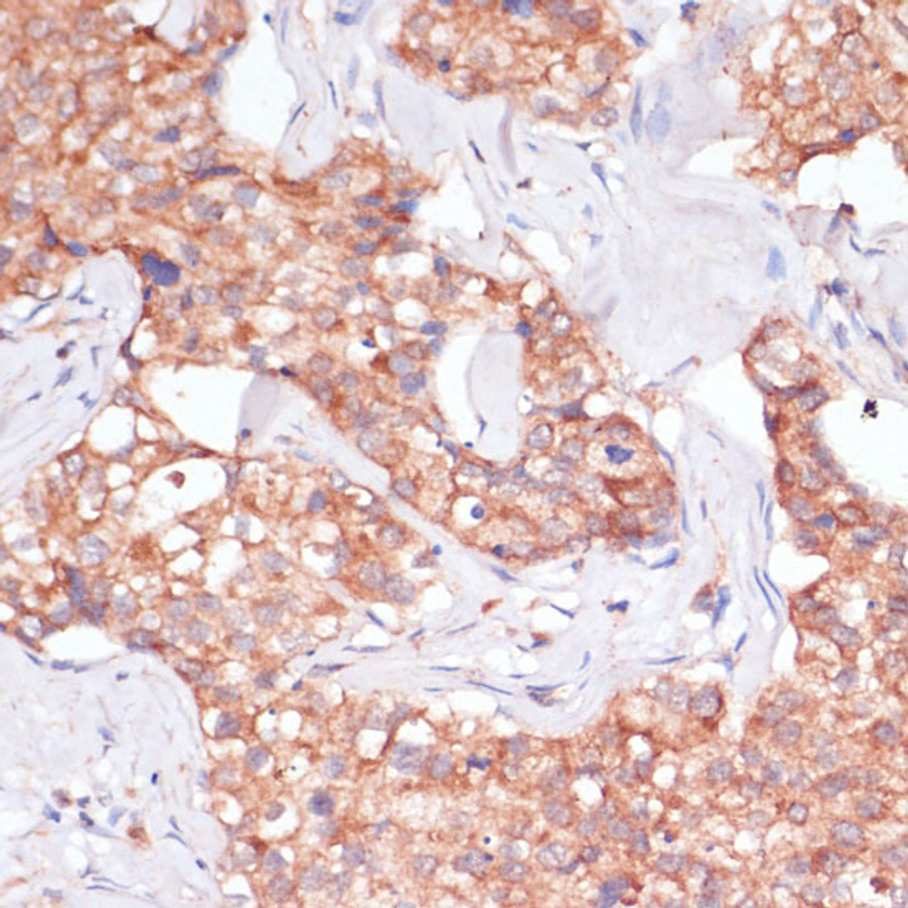 Immunohistochemistry of paraffin-embedded Human breast cancer using TIMM8B Polyclonal Antibody at dilution of  1:100 (40x lens).
