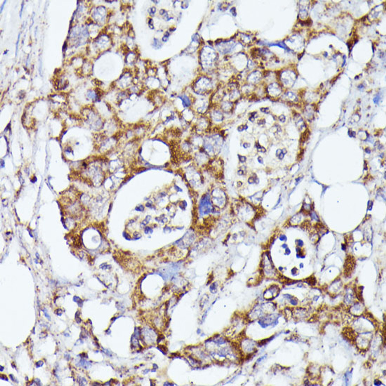 Immunohistochemistry of paraffin-embedded Human colon carcinoma using CDK5RAP1 Polyclonal Antibody at dilution of  1:100 (40x lens).