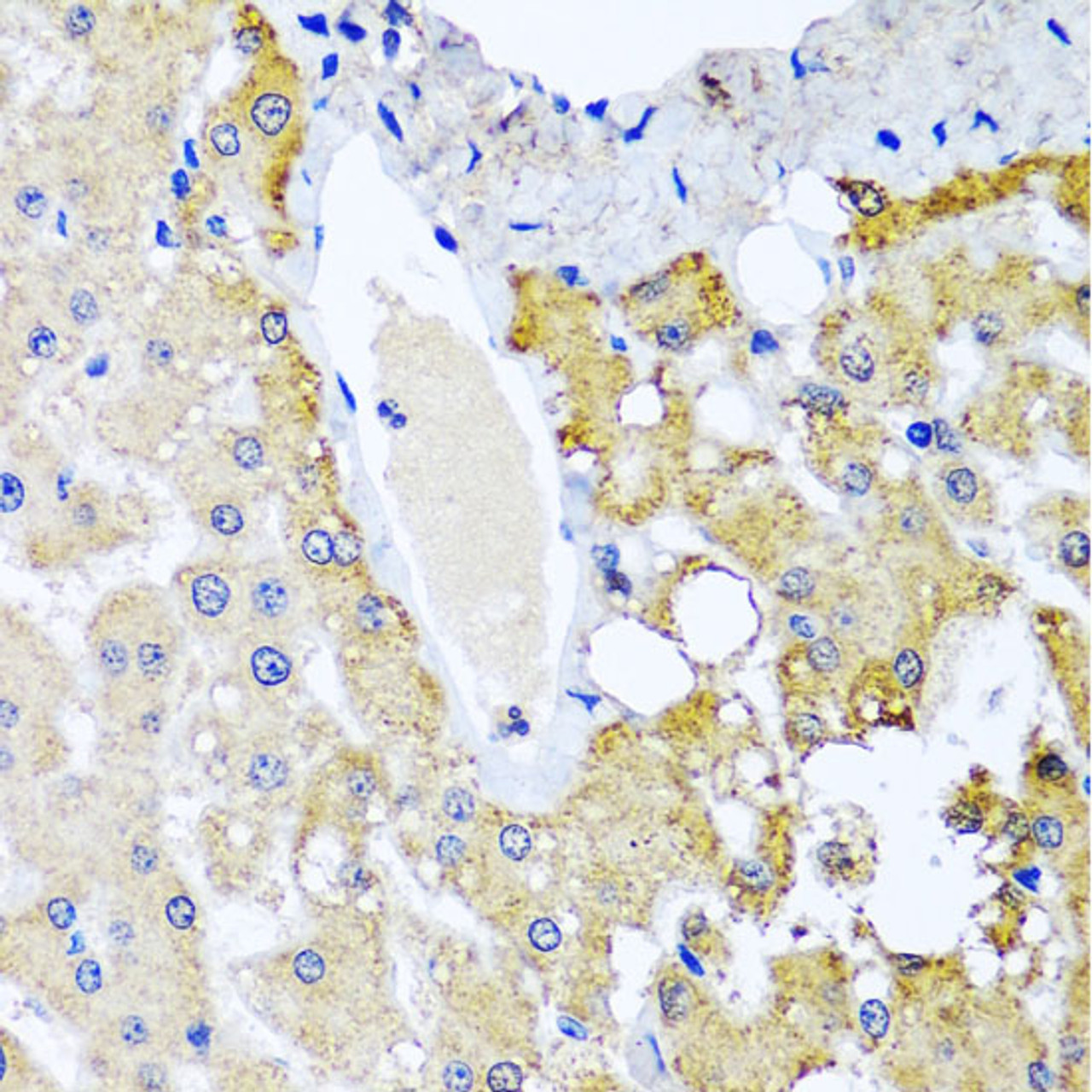 Immunohistochemistry of paraffin-embedded Human liver damage using SULT1A1 Polyclonal Antibody at dilution of  1:100 (40x lens).