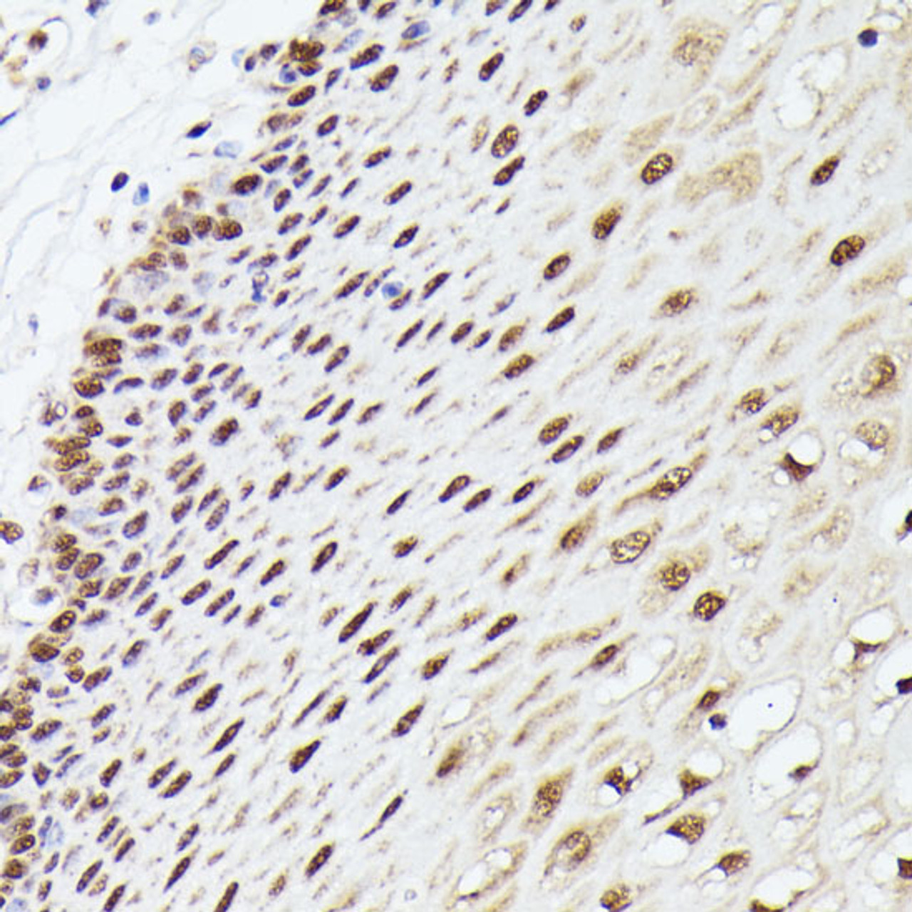 Immunohistochemistry of paraffin-embedded Human esophageal using MLF2 Polyclonal Antibody at dilution of  1:100 (40x lens).