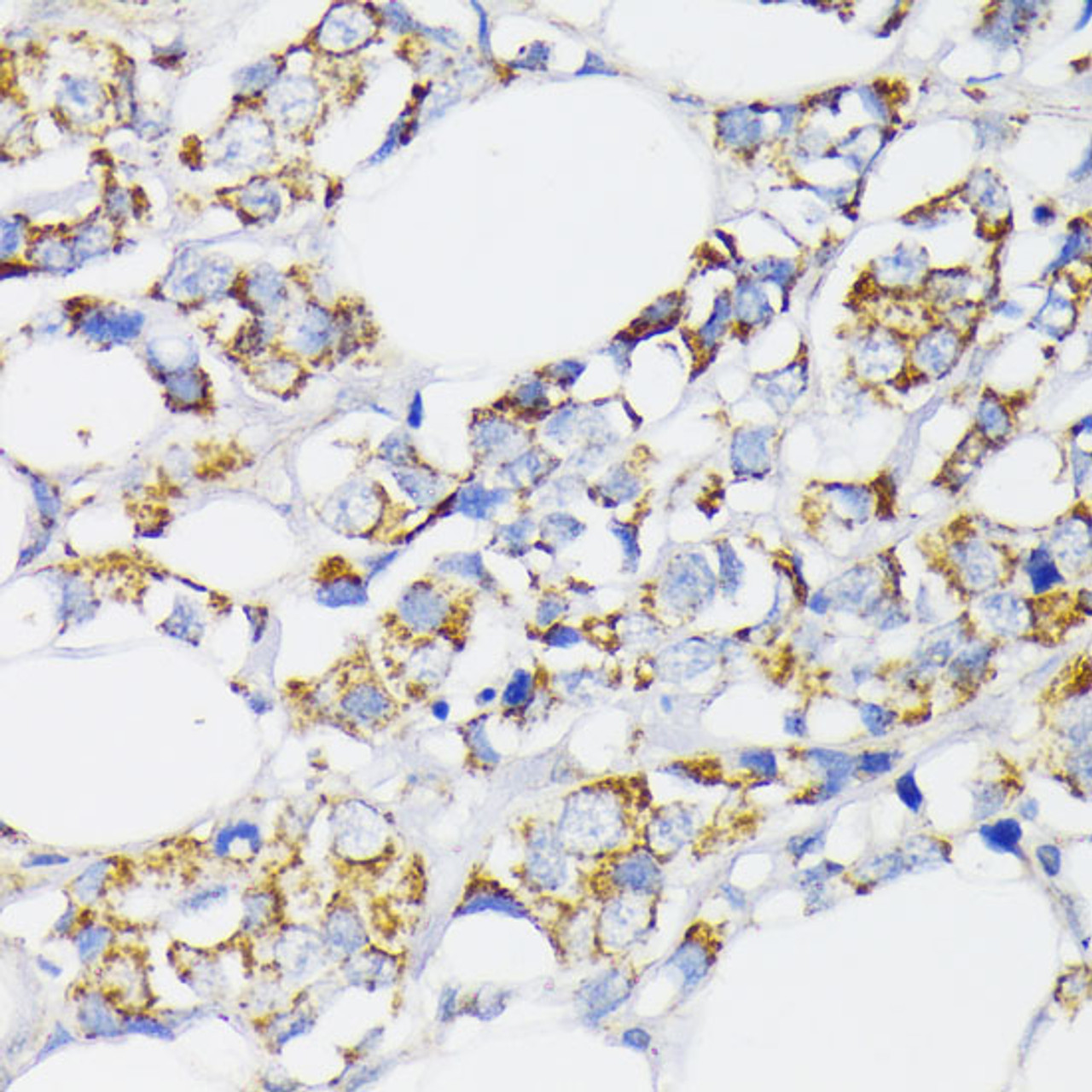 Immunohistochemistry of paraffin-embedded Human breast cancer using USP33 Polyclonal Antibody at dilution of  1:100 (40x lens).