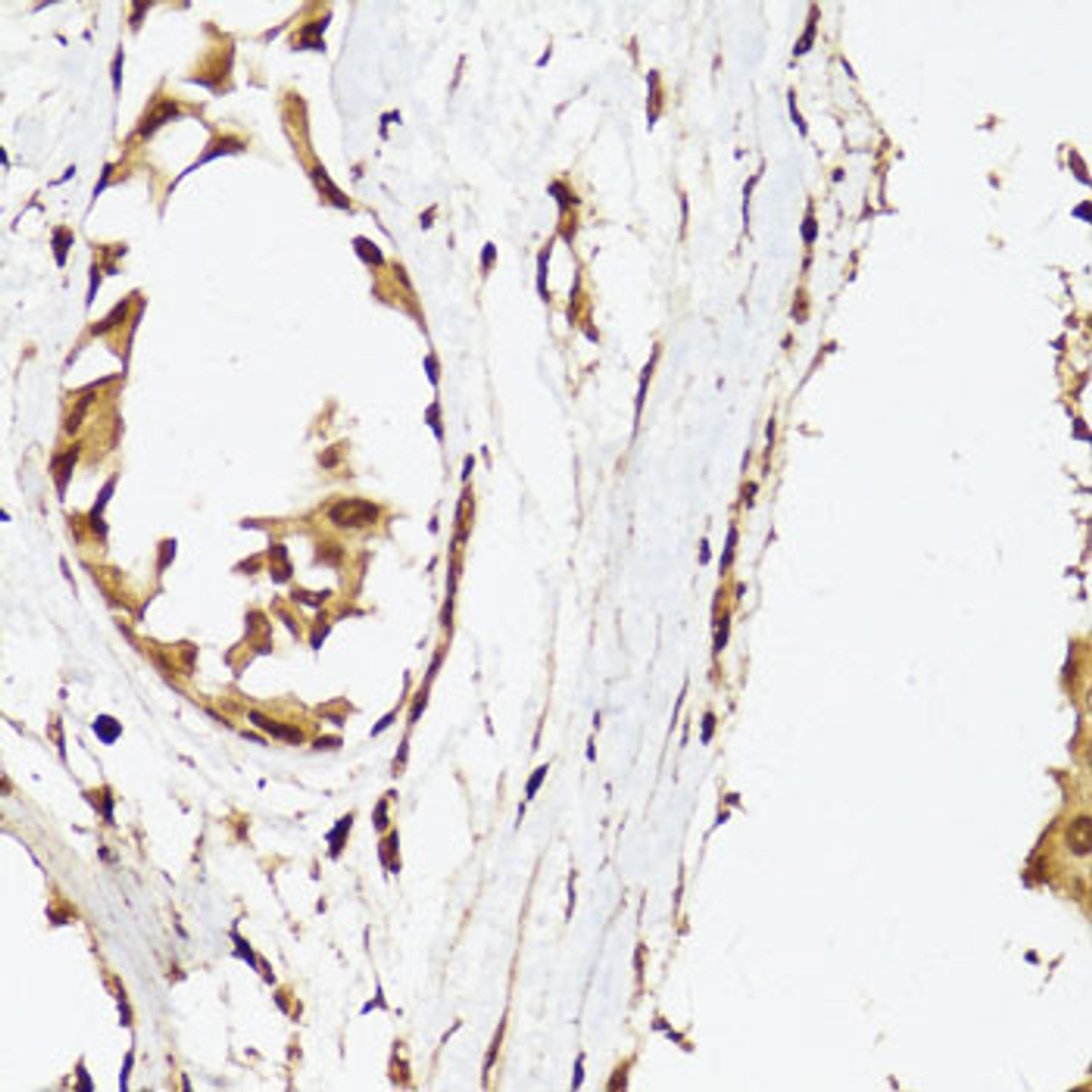 Immunohistochemistry of paraffin-embedded Human mammary cancer using Androgen Receptor Polyclonal Antibody at dilution of  1:150 (40x lens).