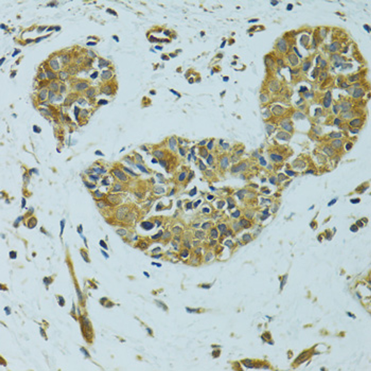 Immunohistochemistry of paraffin-embedded Human breast cancer using HSPB1 Polyclonal Antibody at dilution of  1:100 (40x lens).
