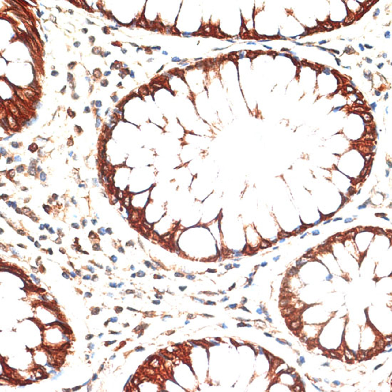 Immunohistochemistry of paraffin-embedded Human colon carcinoma using KRT13 Polyclonal Antibody at dilution of  1:100 (40x lens).