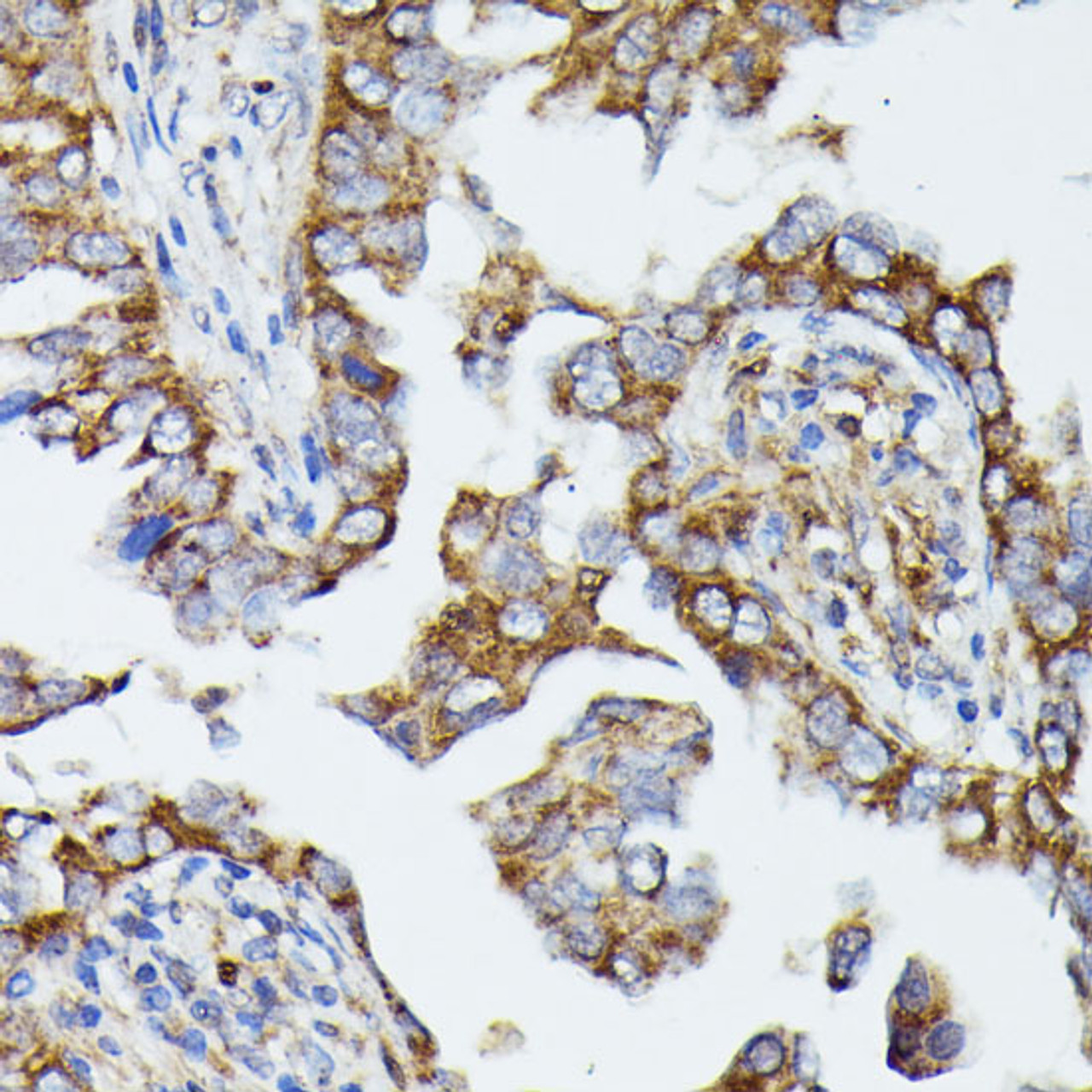Immunohistochemistry of paraffin-embedded Human lung cancer using MTIF2 Polyclonal Antibody at dilution of  1:100 (40x lens).