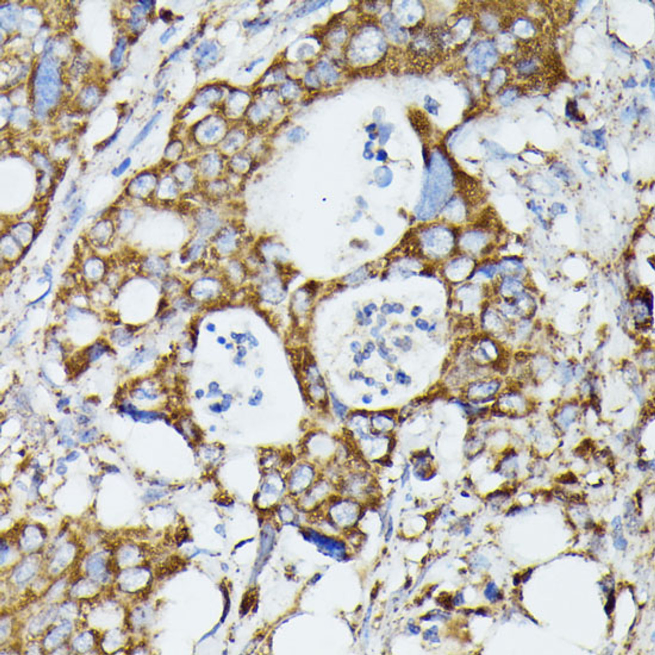 Immunohistochemistry of paraffin-embedded Human colon carcinoma using MTIF2 Polyclonal Antibody at dilution of  1:100 (40x lens).