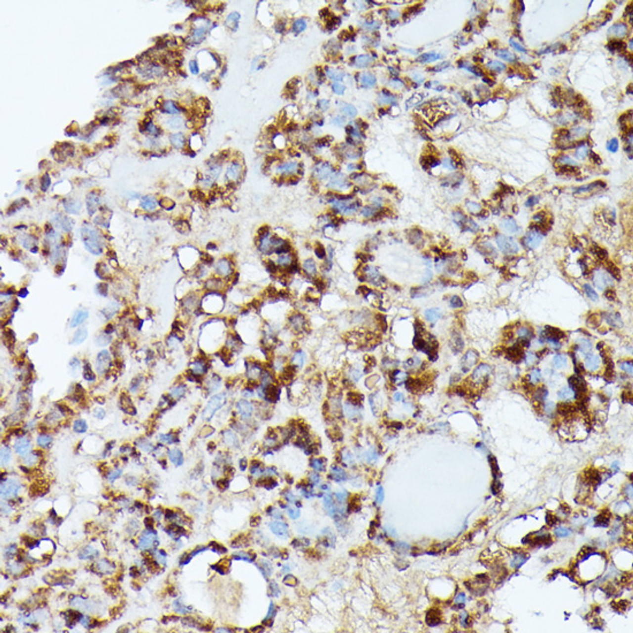 Immunohistochemistry of paraffin-embedded Human thyroid cancer using NUBP1 Polyclonal Antibody at dilution of  1:100 (40x lens).