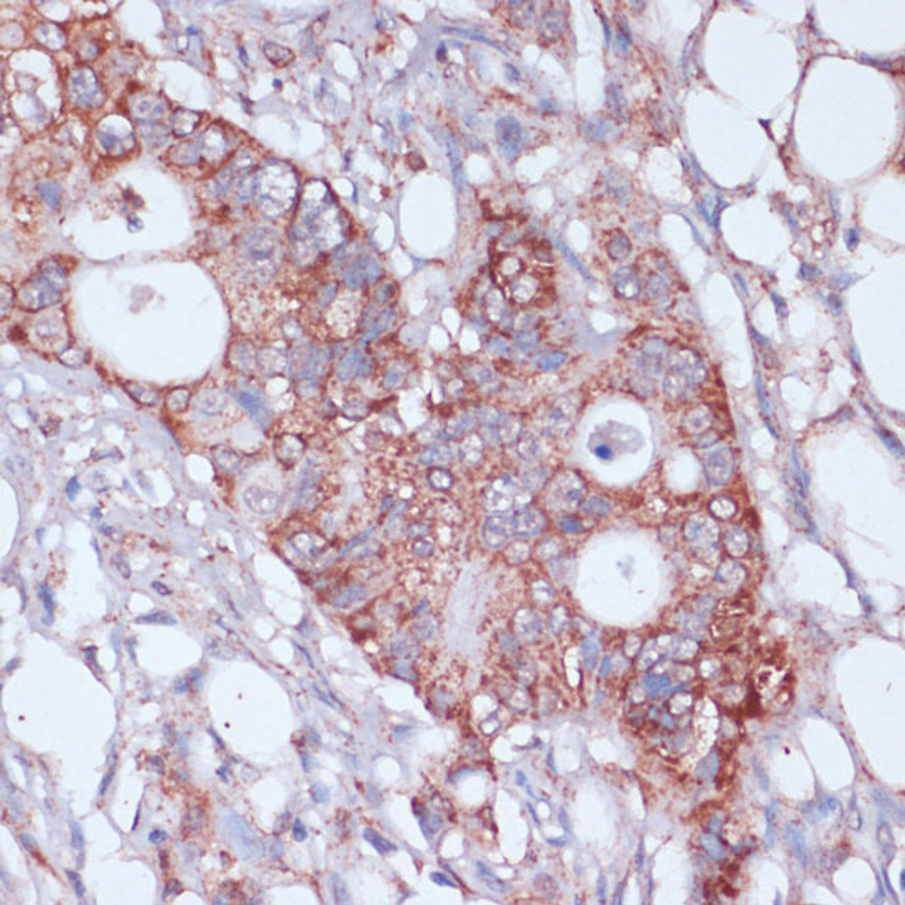 Immunohistochemistry of paraffin-embedded Human colon carcinoma using MRPL23 Polyclonal Antibody at dilution of  1:100 (40x lens).