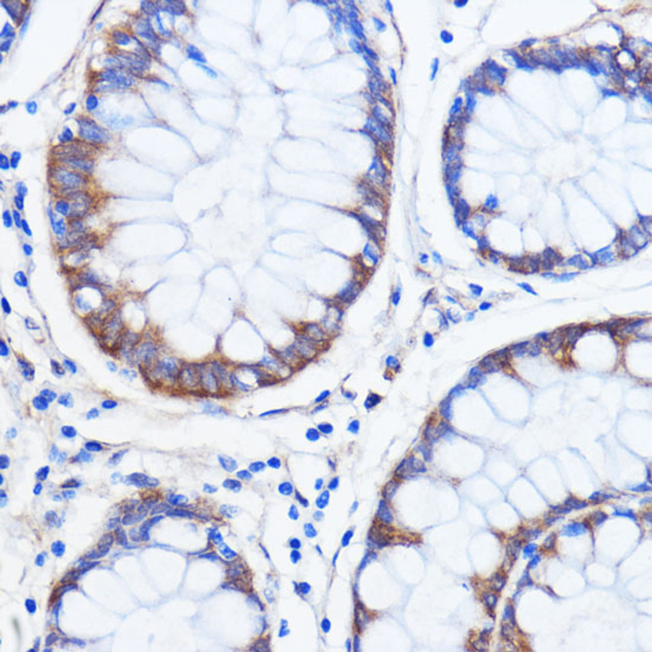 Immunohistochemistry of paraffin-embedded Human colon carcinoma using ATXN2 Polyclonal Antibody at dilution of  1:100 (40x lens).