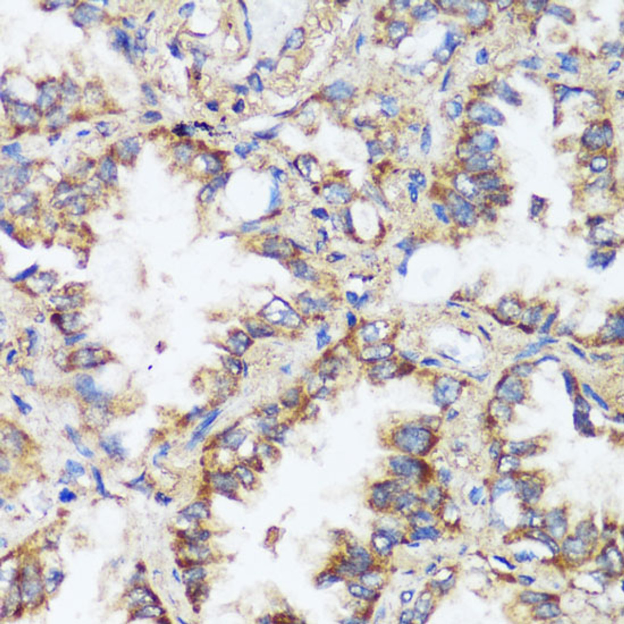 Immunohistochemistry of paraffin-embedded Human lung cancer using ERK1 / ERK2 Polyclonal Antibody at dilution of  1:200 (40x lens).