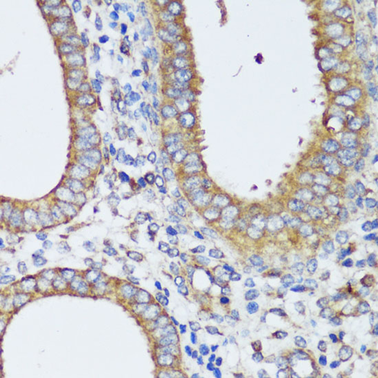 Immunohistochemistry of paraffin-embedded Human uterine cancer using ERK1 / ERK2 Polyclonal Antibody at dilution of  1:200 (40x lens).