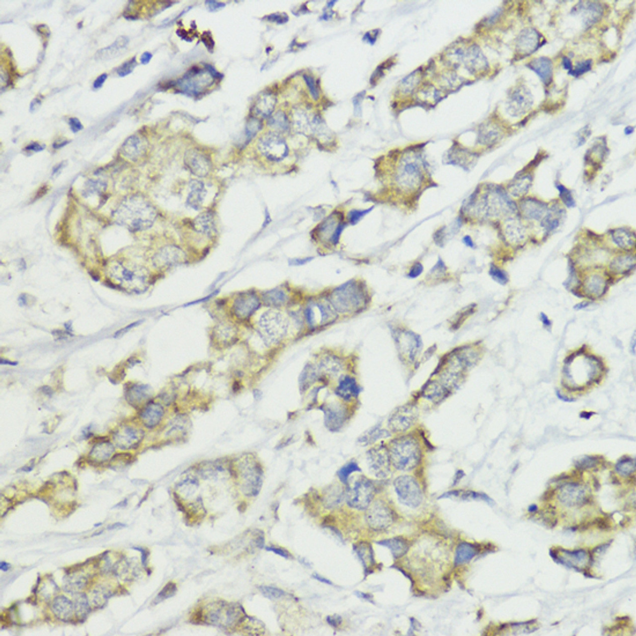 Immunohistochemistry of paraffin-embedded Human mammary cancer using CCNB1 Polyclonal Antibody at dilution of  1:100 (40x lens).
