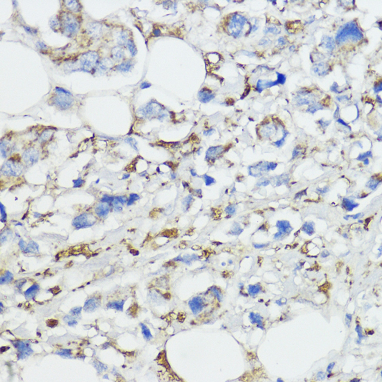Immunohistochemistry of paraffin-embedded Human mammary cancer using FXN Polyclonal Antibody at dilution of  1:100 (40x lens).