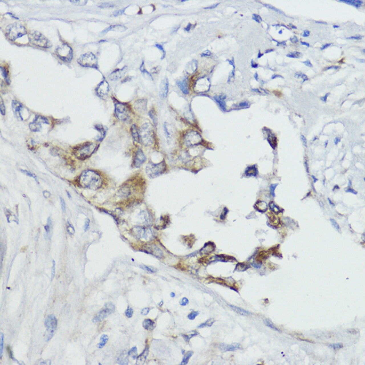 Immunohistochemistry of paraffin-embedded Human lung cancer using FXN Polyclonal Antibody at dilution of  1:100 (40x lens).