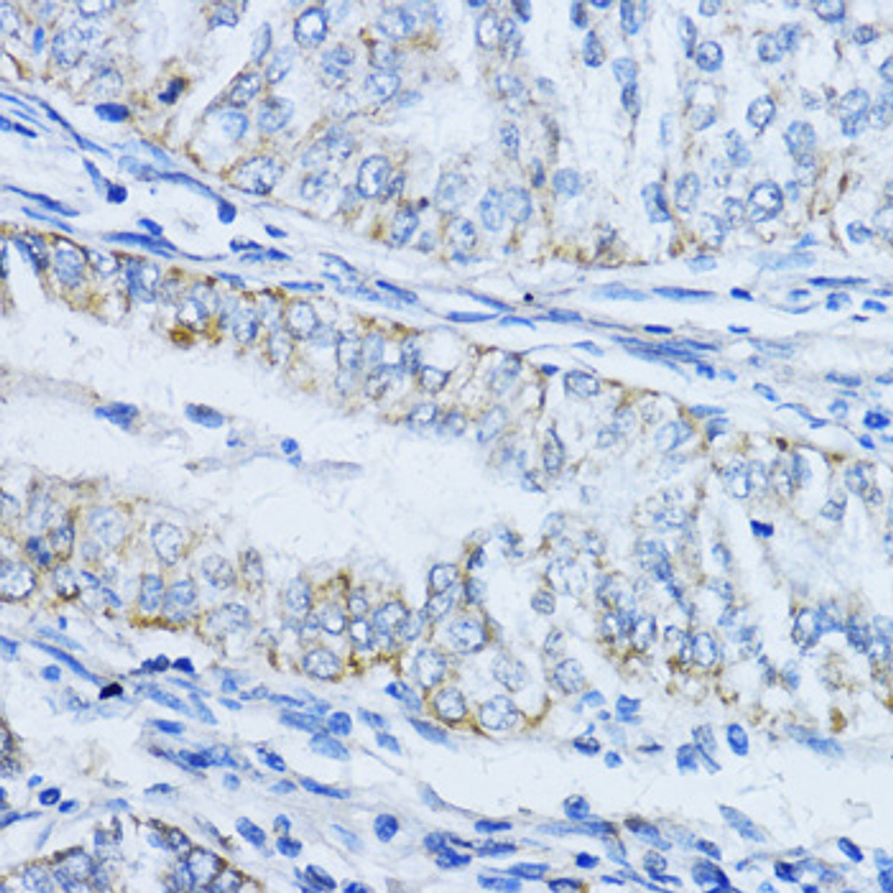 Immunohistochemistry of paraffin-embedded Human colon carcinoma using VIL1 Polyclonal Antibody at dilution of  1:100 (40x lens).