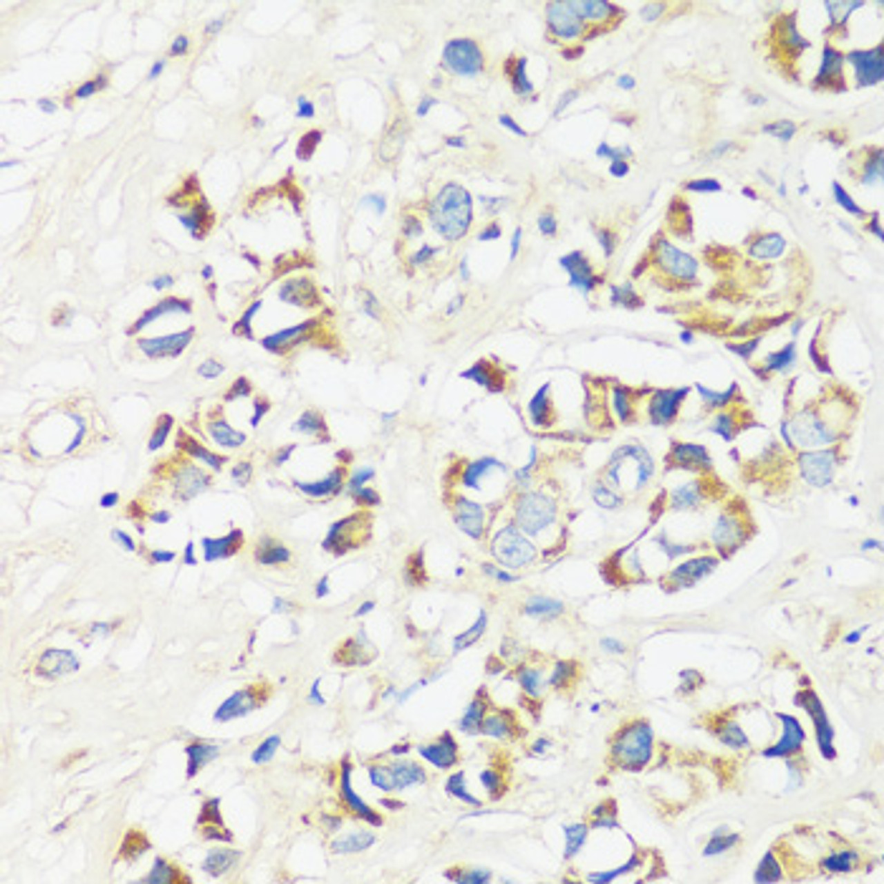 Immunohistochemistry of paraffin-embedded Human breast cancer using CADPS Polyclonal Antibody at dilution of  1:100 (40x lens).