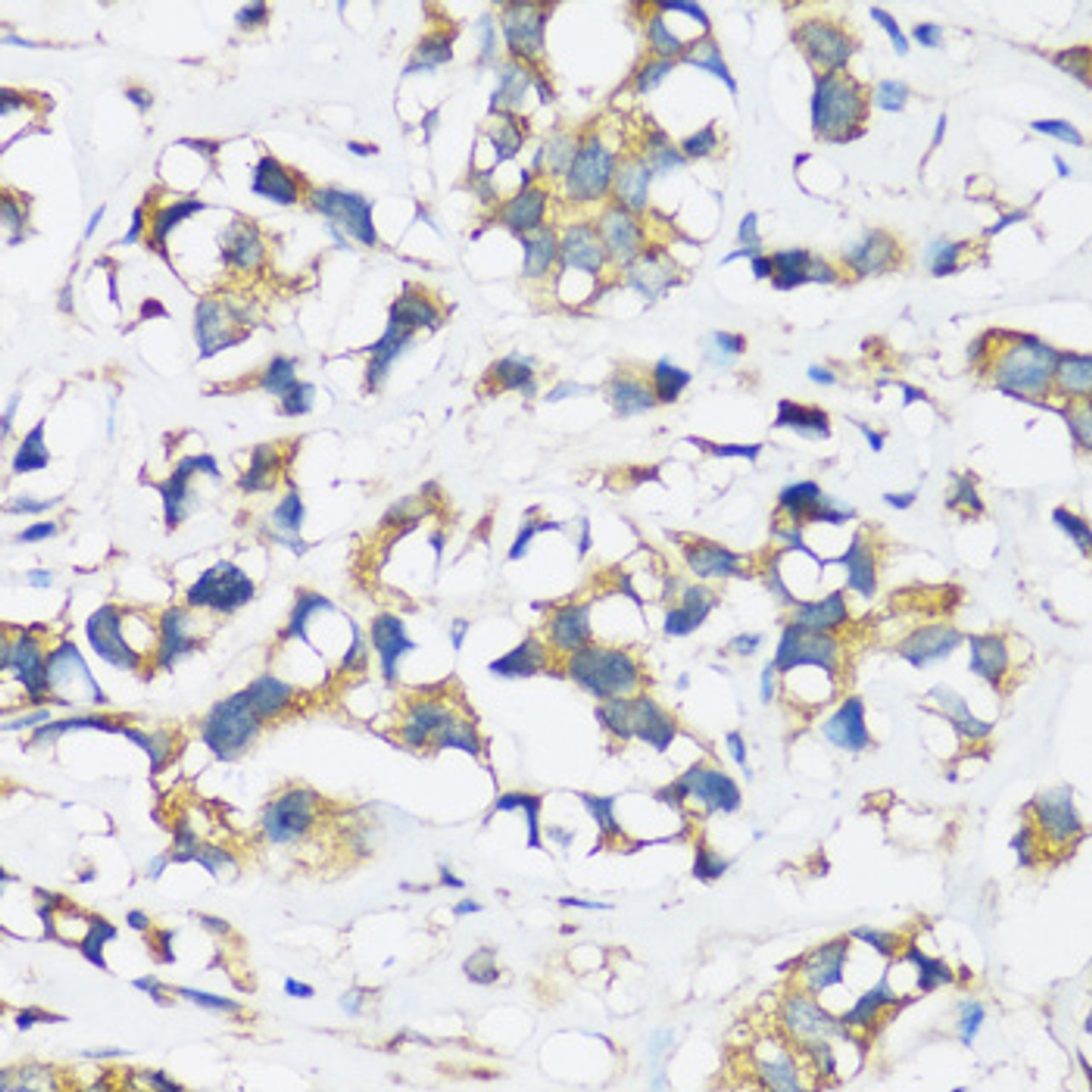 Immunohistochemistry of paraffin-embedded Human breast cancer using ARFIP2 Polyclonal Antibody at dilution of  1:100 (40x lens).