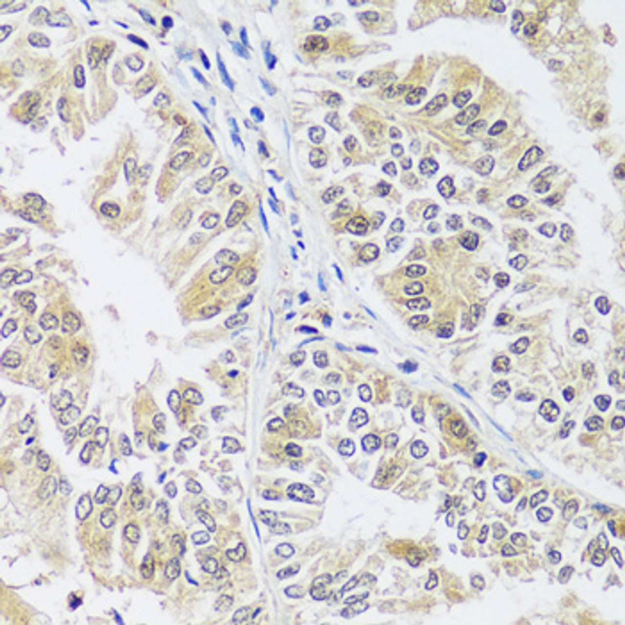 Immunohistochemistry of paraffin-embedded Human uterine cancer using C12orf10 Polyclonal Antibody at dilution of  1:100 (40x lens).