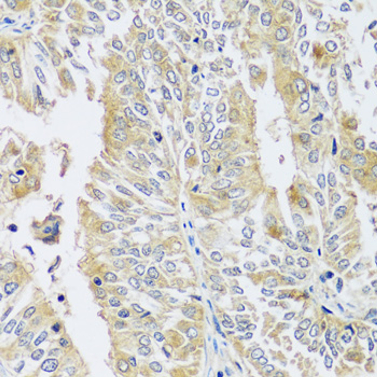 Immunohistochemistry of paraffin-embedded Human uterine cancer using BLOC1S3 Polyclonal Antibody at dilution of  1:100 (40x lens).