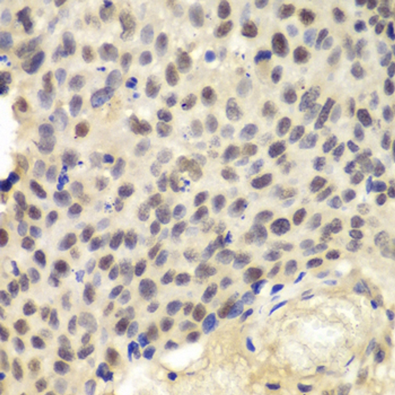 Immunohistochemistry of paraffin-embedded Human lung cancer using KPNA1 Polyclonal Antibody at dilution of  1:100 (40x lens).