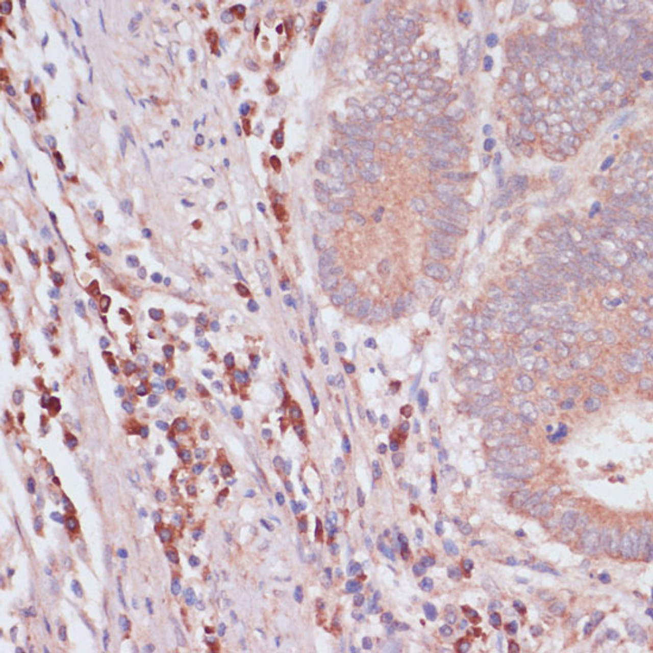 Immunohistochemistry of paraffin-embedded Human colon carcinoma using IFNAR2 Polyclonal Antibody at dilution of  1:100 (40x lens).