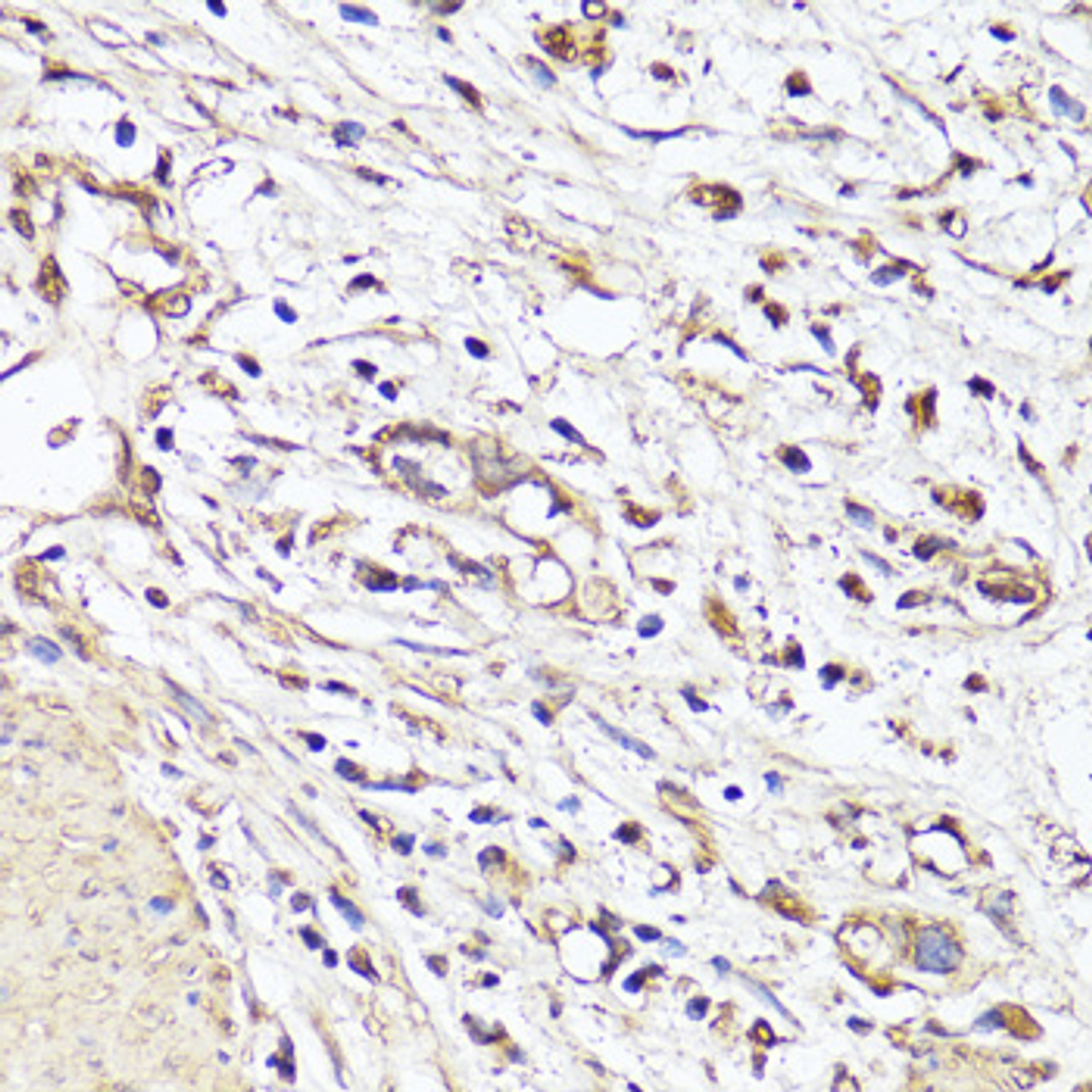 Immunohistochemistry of paraffin-embedded Human stomach cancer using VEGF Monoclonal Antibody at dilution of  1:150 (40x lens).