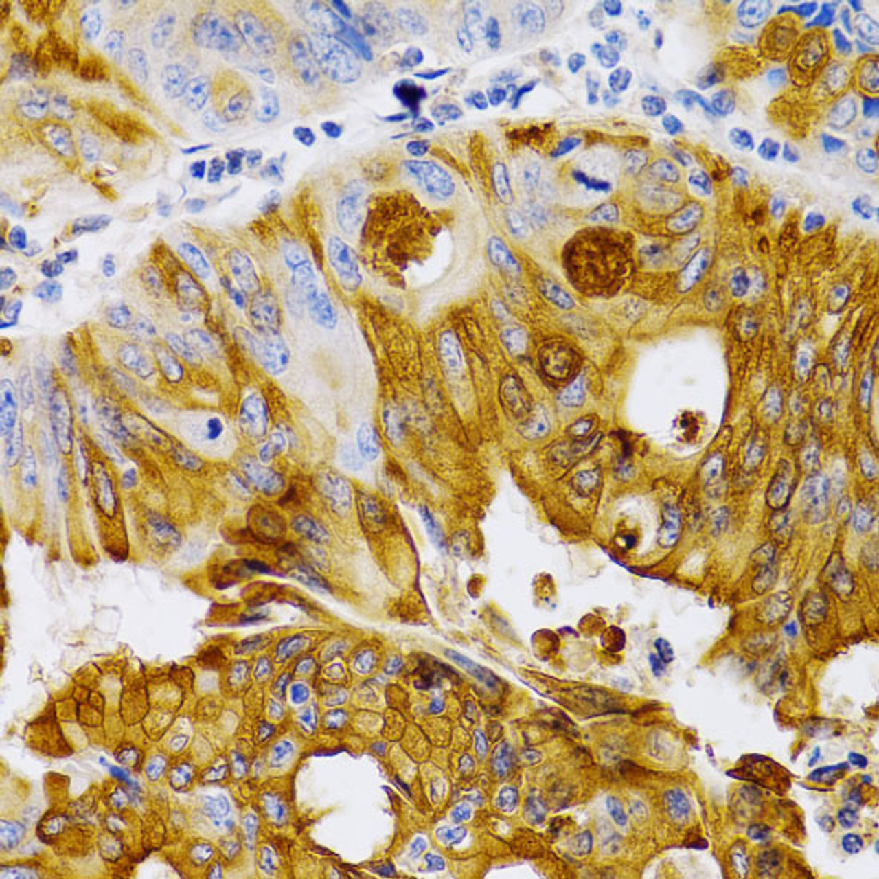 Immunohistochemistry of paraffin-embedded Human colon carcinoma using TFF1 Polyclonal Antibody at dilution of  1:200 (40x lens).