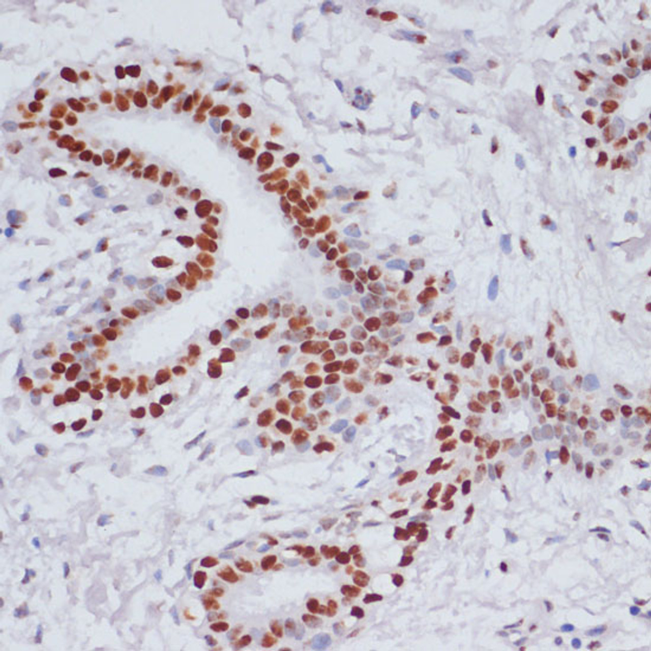 Immunohistochemistry of paraffin-embedded Human breast cancer using Acetyl-Histone H3-K9/K14/K18/K23/K27 Polyclonal Antibody at dilution of  1:100 (40x lens).