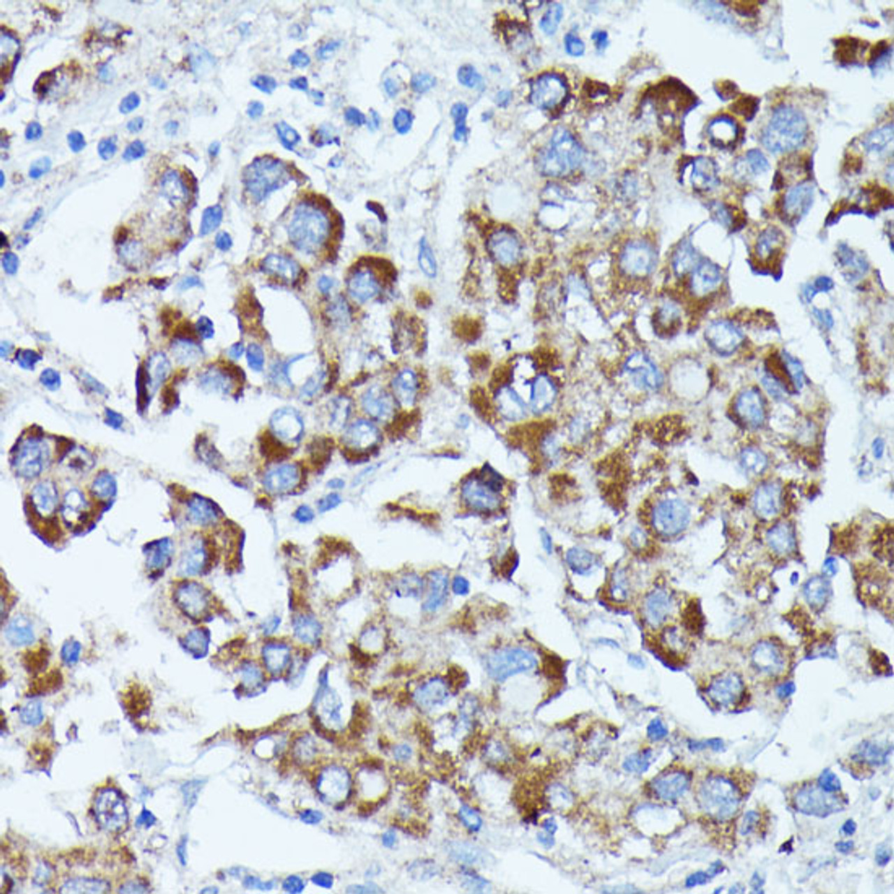 Immunohistochemistry of paraffin-embedded Human liver cancer using PDE3A Polyclonal Antibody at dilution of  1:100 (40x lens).
