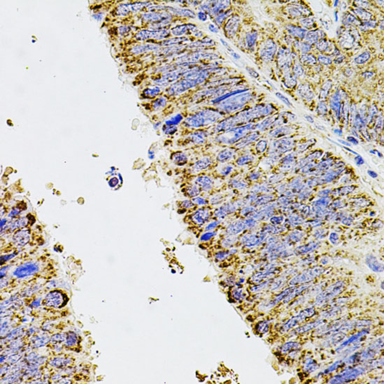 Immunohistochemistry of paraffin-embedded Human colon carcinoma using ALDH1A1 Polyclonal Antibody at dilution of  1:100 (40x lens).