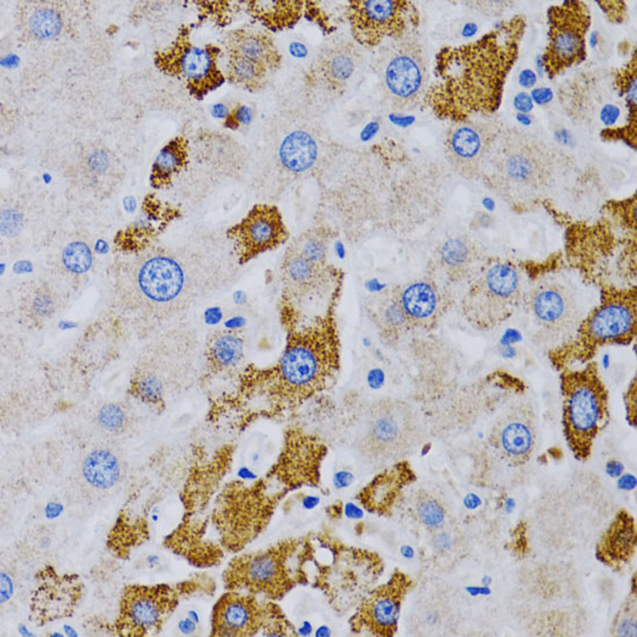 Immunohistochemistry of paraffin-embedded Human liver cancer using CYP24A1 Polyclonal Antibody at dilution of  1:200 (40x lens).
