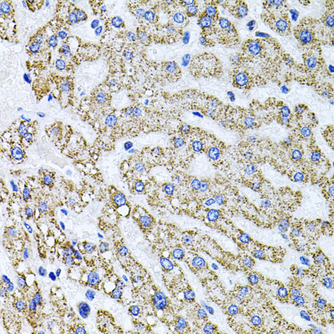 Immunohistochemistry of paraffin-embedded Human liver damage using SDC2 Polyclonal Antibody at dilution of  1:100 (40x lens).