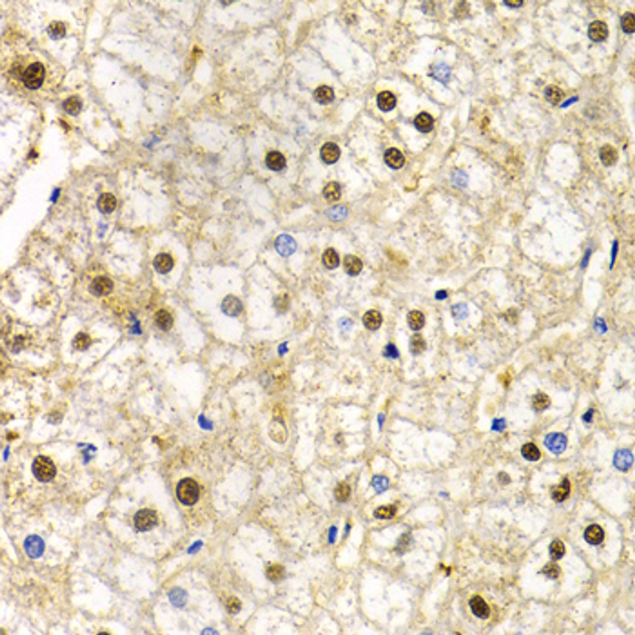 Immunohistochemistry of paraffin-embedded Human liver damage using RAD9A Polyclonal Antibody at dilution of  1:200 (40x lens).