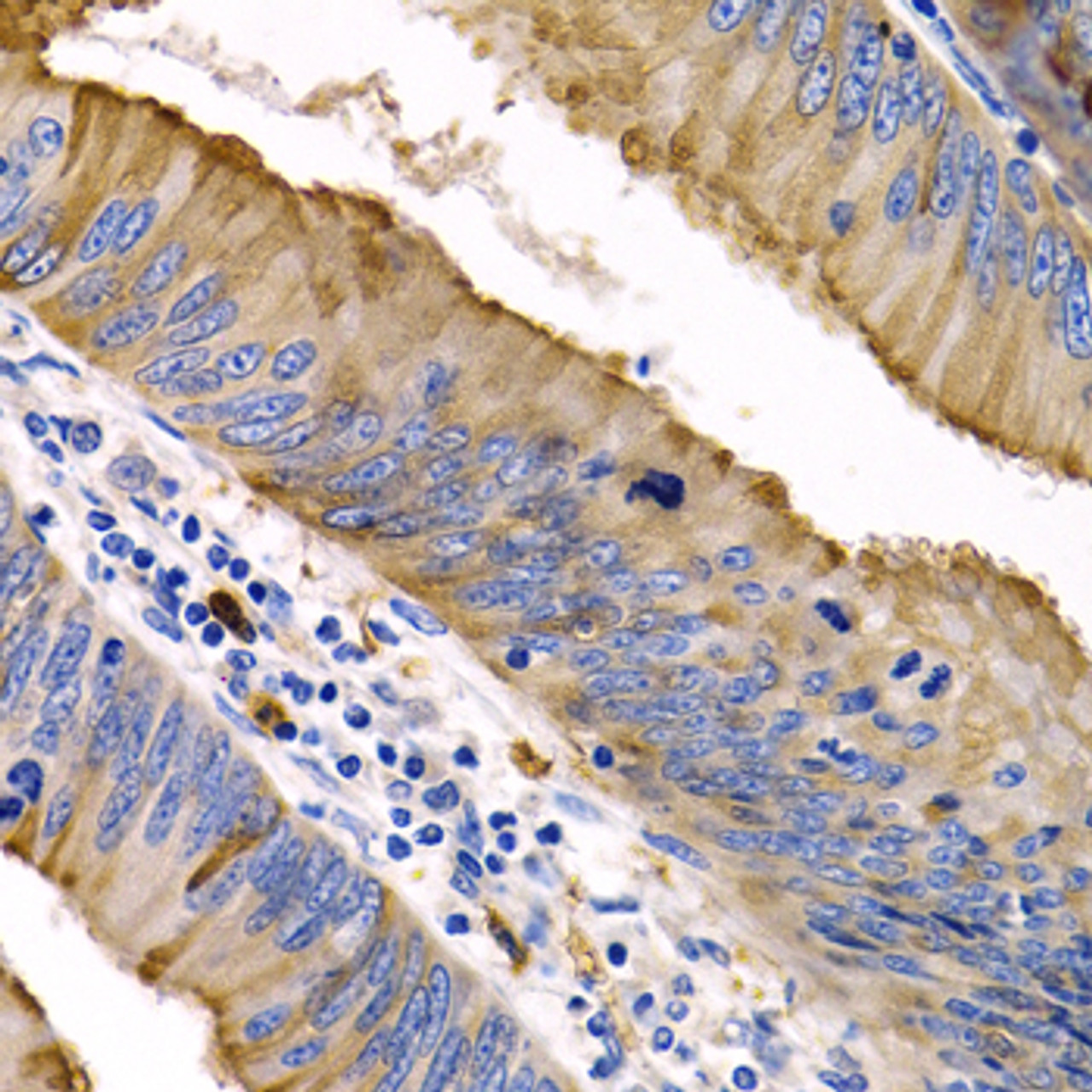 Immunohistochemistry of paraffin-embedded Human colon cancer using IL9 Polyclonal Antibody at dilution of  1:200 (40x lens).