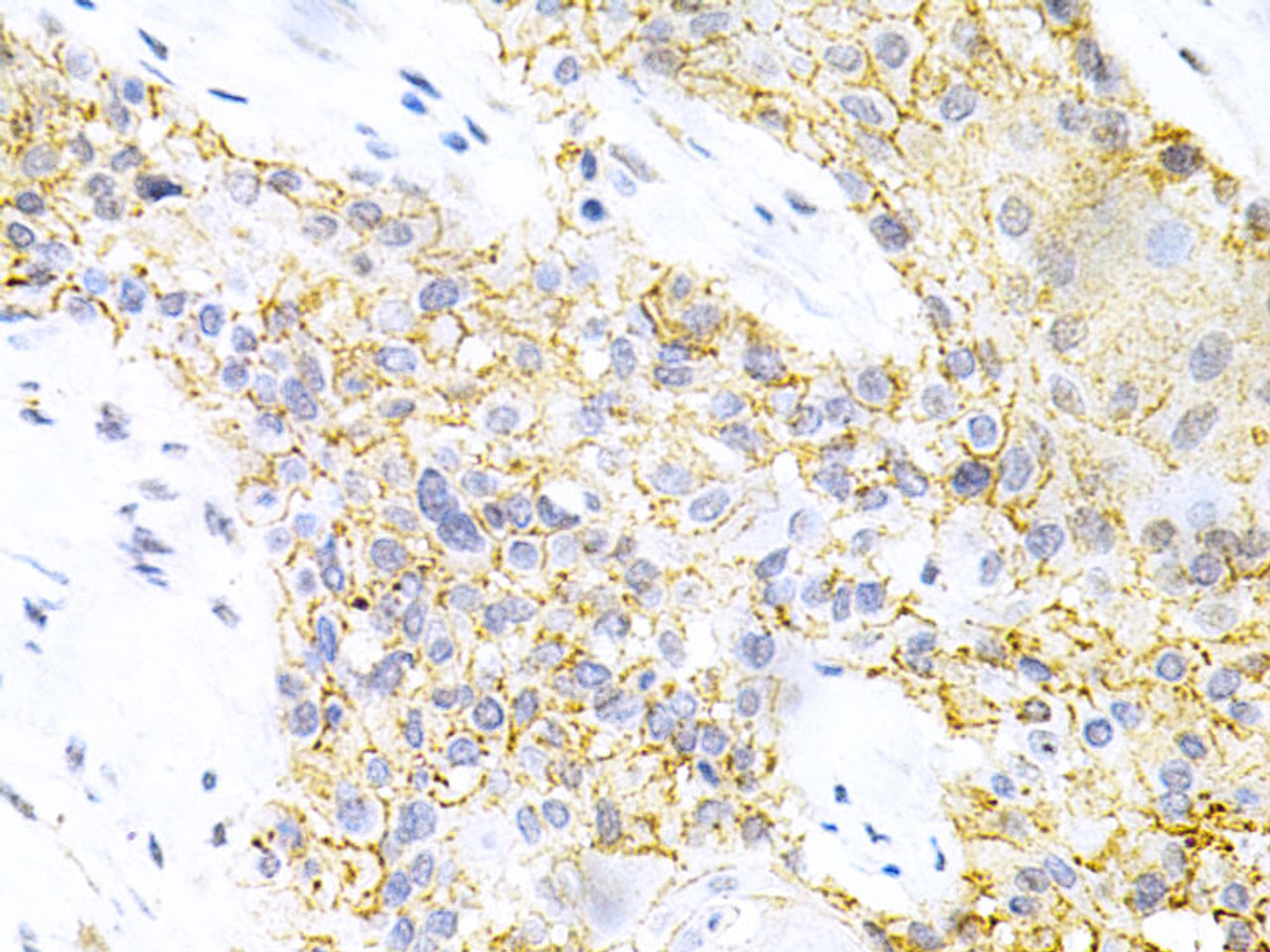 Immunohistochemistry of paraffin-embedded Human esophageal cancer using PPP2R4 Polyclonal Antibody at dilution of  1:200 (40x lens).