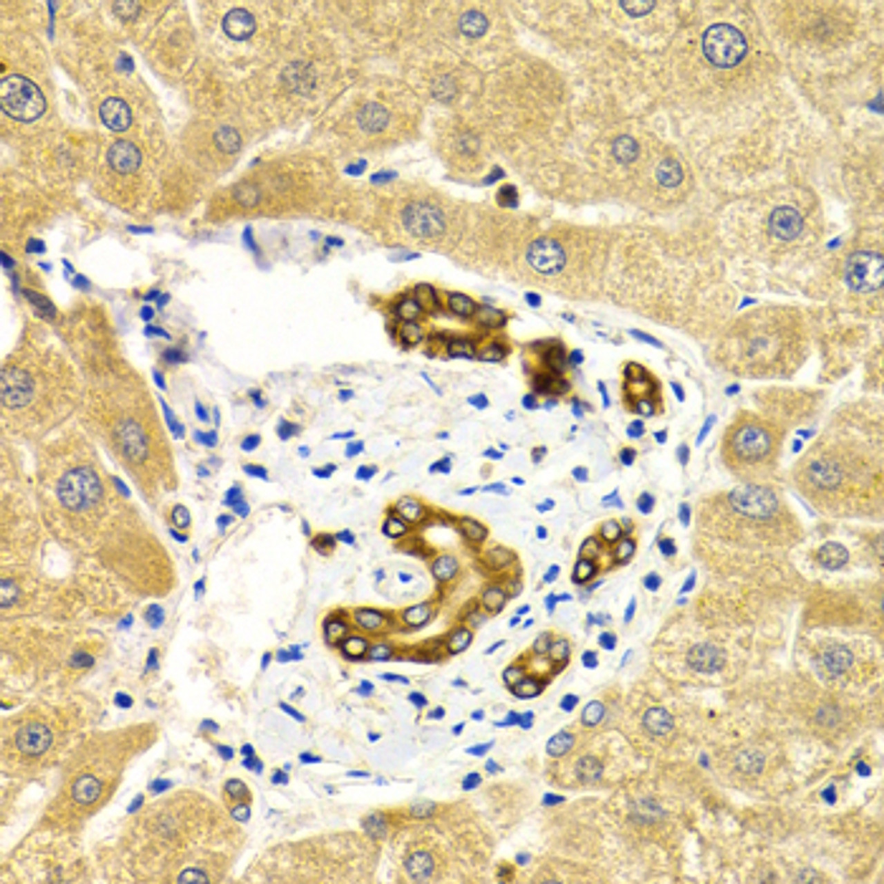 Immunohistochemistry of paraffin-embedded Human liver damage using RAB27A Polyclonal Antibody at dilution of  1:200 (40x lens).