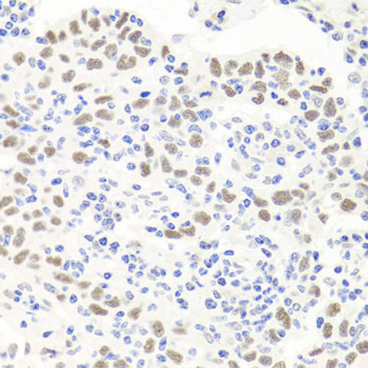 Immunohistochemistry of paraffin-embedded Human esophageal cancer using EXO1 Polyclonal Antibody at dilution of  1:100 (40x lens).