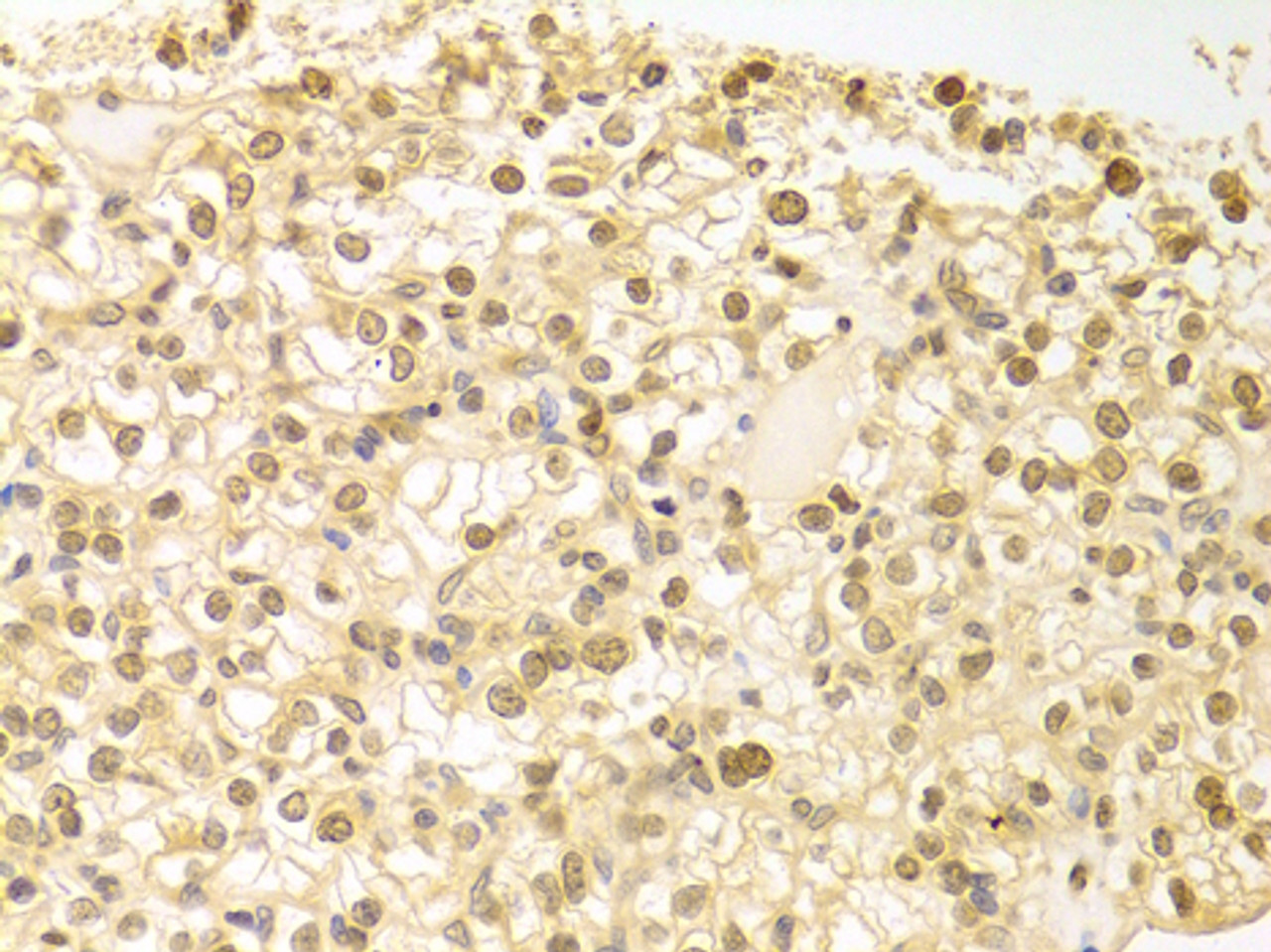 Immunohistochemistry of paraffin-embedded Human kidney cancer using PLCB1 Polyclonal Antibody at dilution of  1:100 (40x lens).