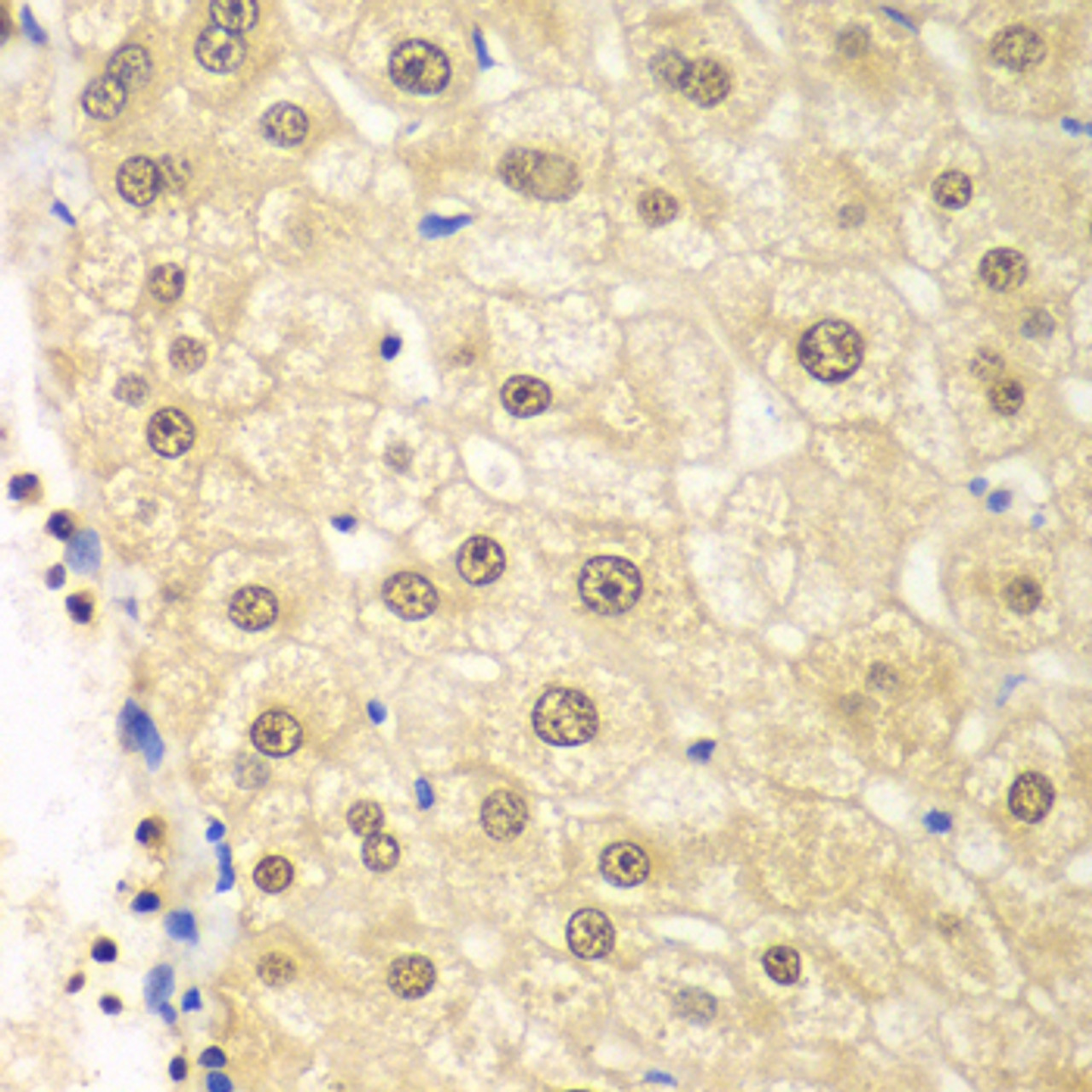 Immunohistochemistry of paraffin-embedded Human liver damage using PSMD2 Polyclonal Antibody at dilution of  1:100 (40x lens).