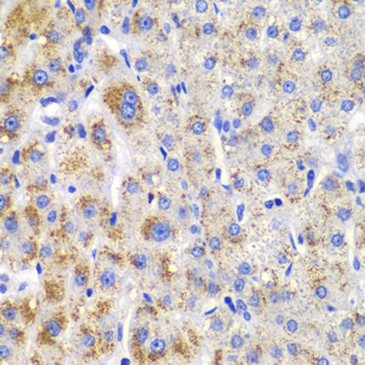 Immunohistochemistry of paraffin-embedded Human liver damage using CBLB Polyclonal Antibody at dilution of  1:200 (40x lens).