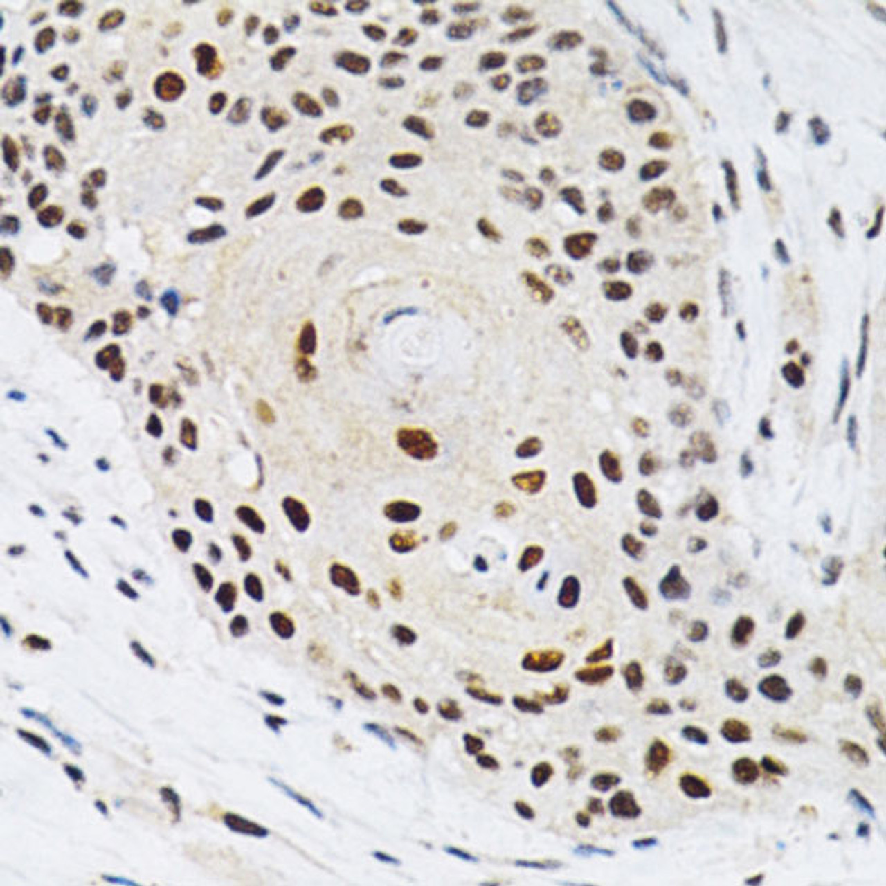 Immunohistochemistry of paraffin-embedded Human esophageal cancer using KPNA4 Polyclonal Antibody at dilution of  1:200 (40x lens).