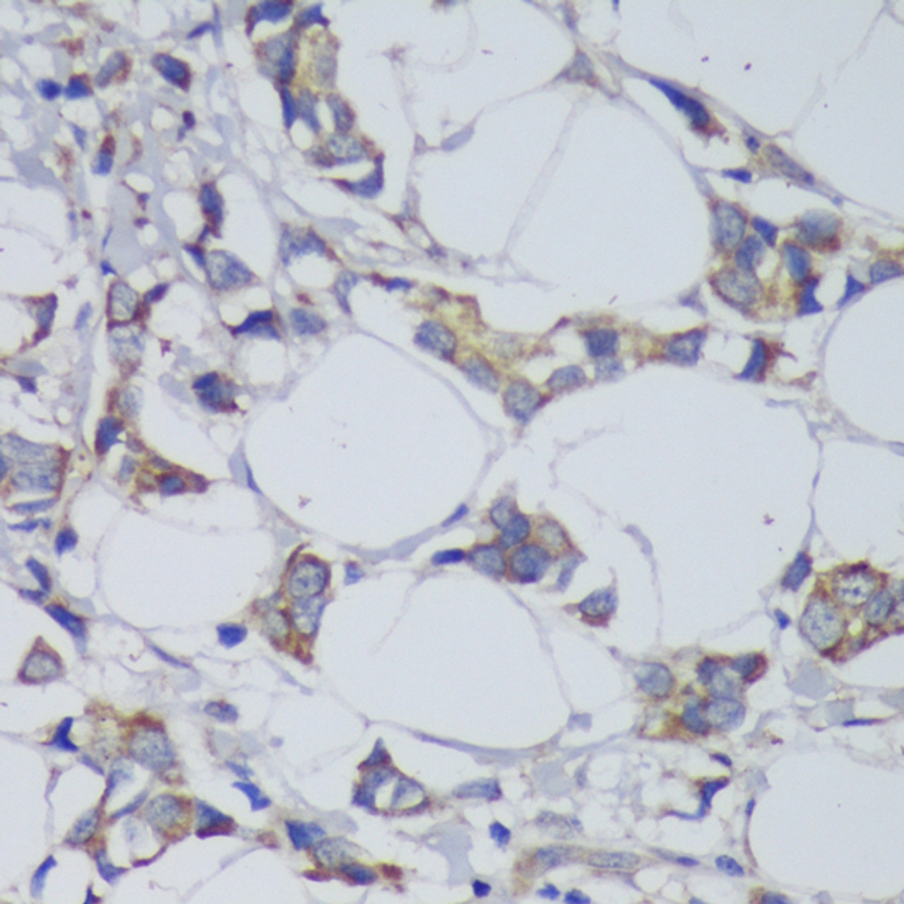 Immunohistochemistry of paraffin-embedded Human mammary cancer using GSK3B Polyclonal Antibody at dilution of  1:200 (40x lens).