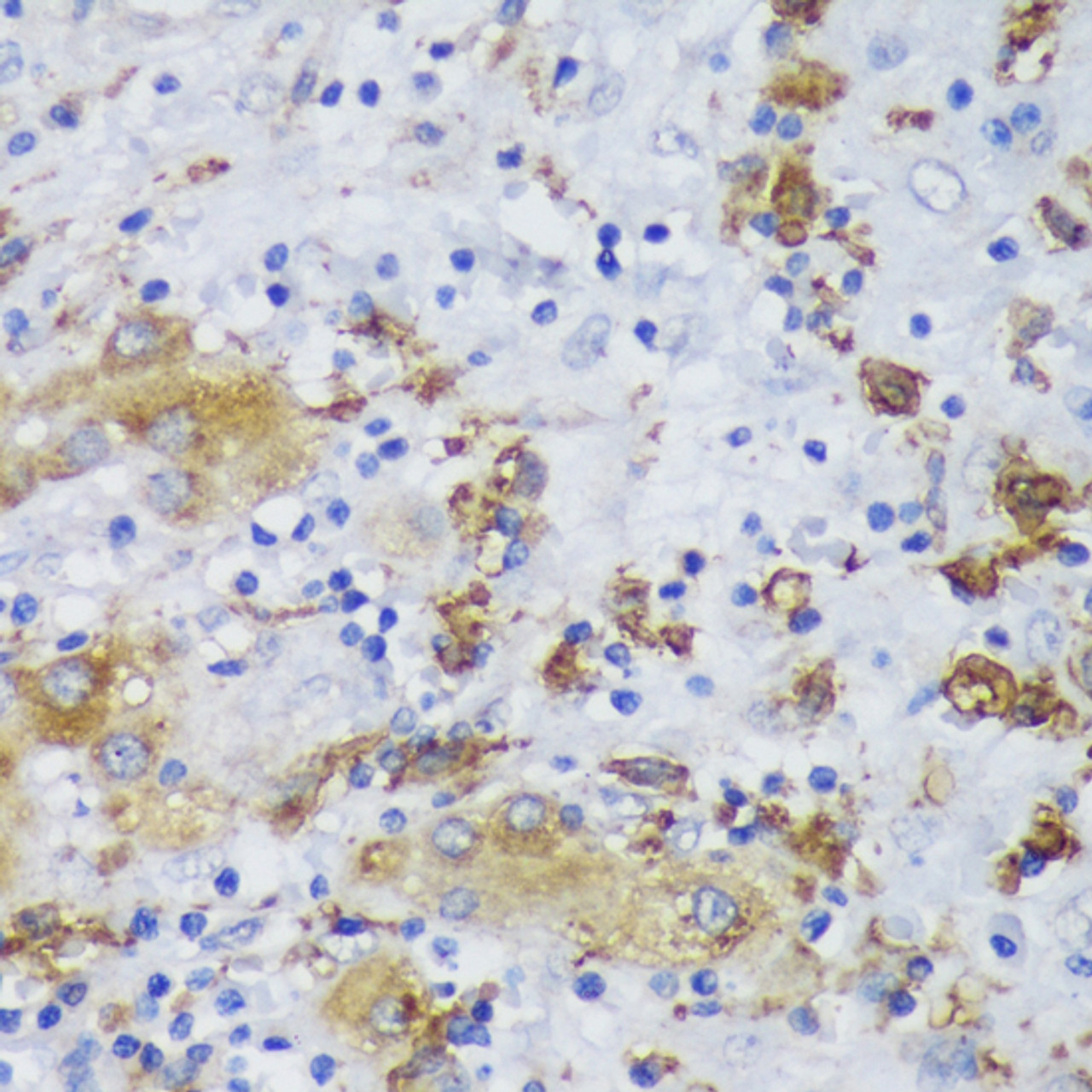 Immunohistochemistry of paraffin-embedded Human liver cancer using GSK3B Polyclonal Antibody at dilution of  1:200 (40x lens).