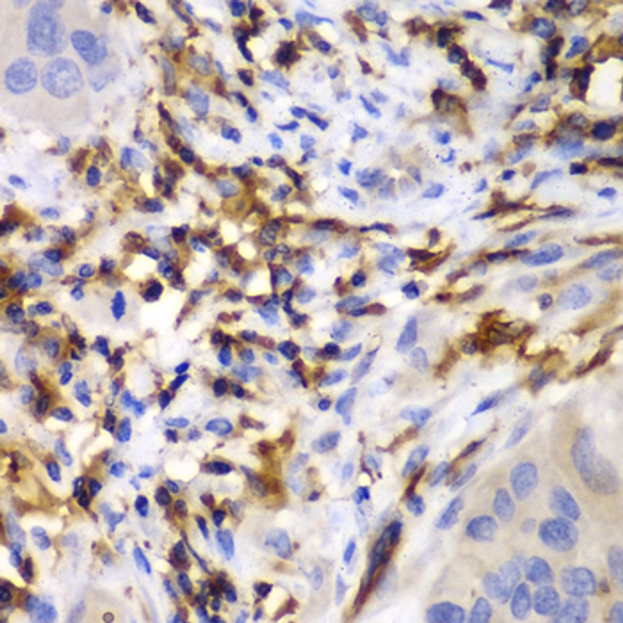 Immunohistochemistry of paraffin-embedded Human liver cancer using HCLS1 Polyclonal Antibody at dilution of  1:100 (40x lens).