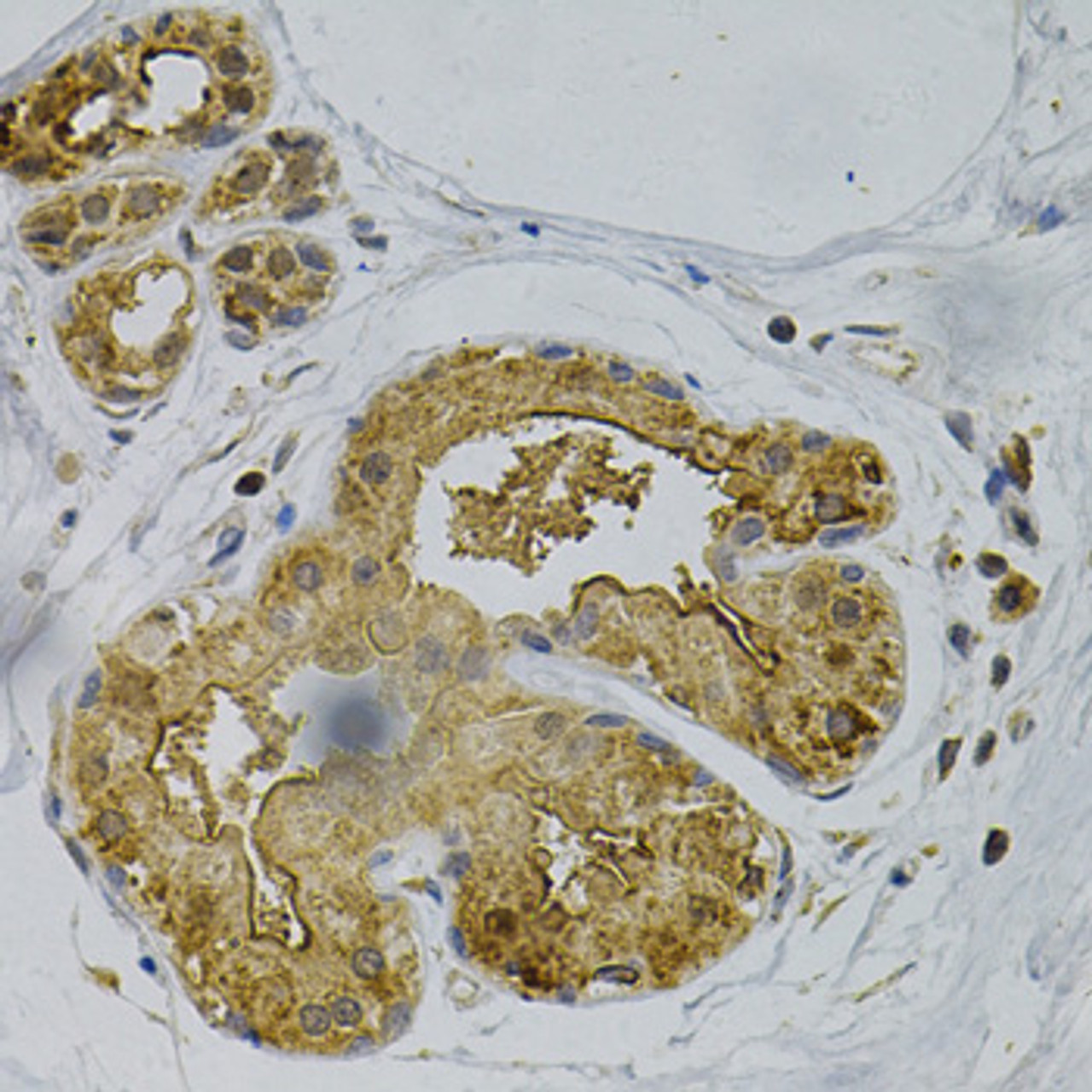 Immunohistochemistry of paraffin-embedded Human breast cancer using PSEN1 Polyclonal Antibody at dilution of  1:100 (40x lens).