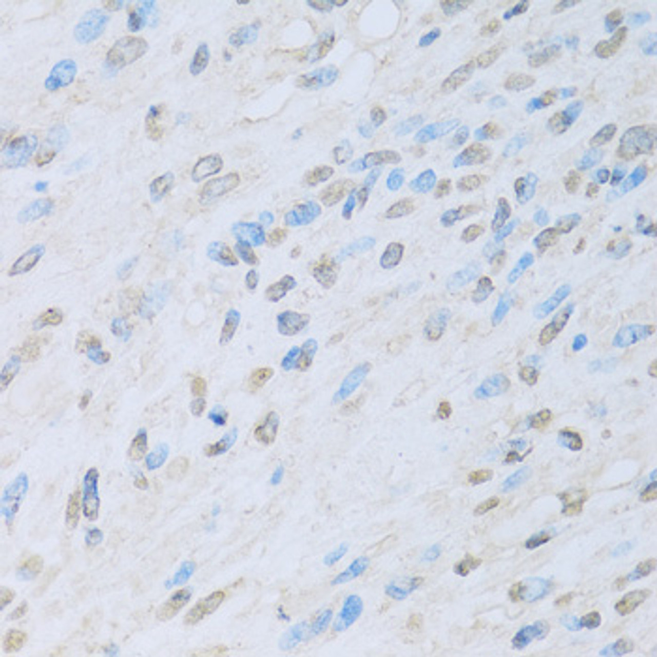 Immunohistochemistry of paraffin-embedded Human liver cancer using KAT2A Polyclonal Antibody at dilution of  1:100 (40x lens).