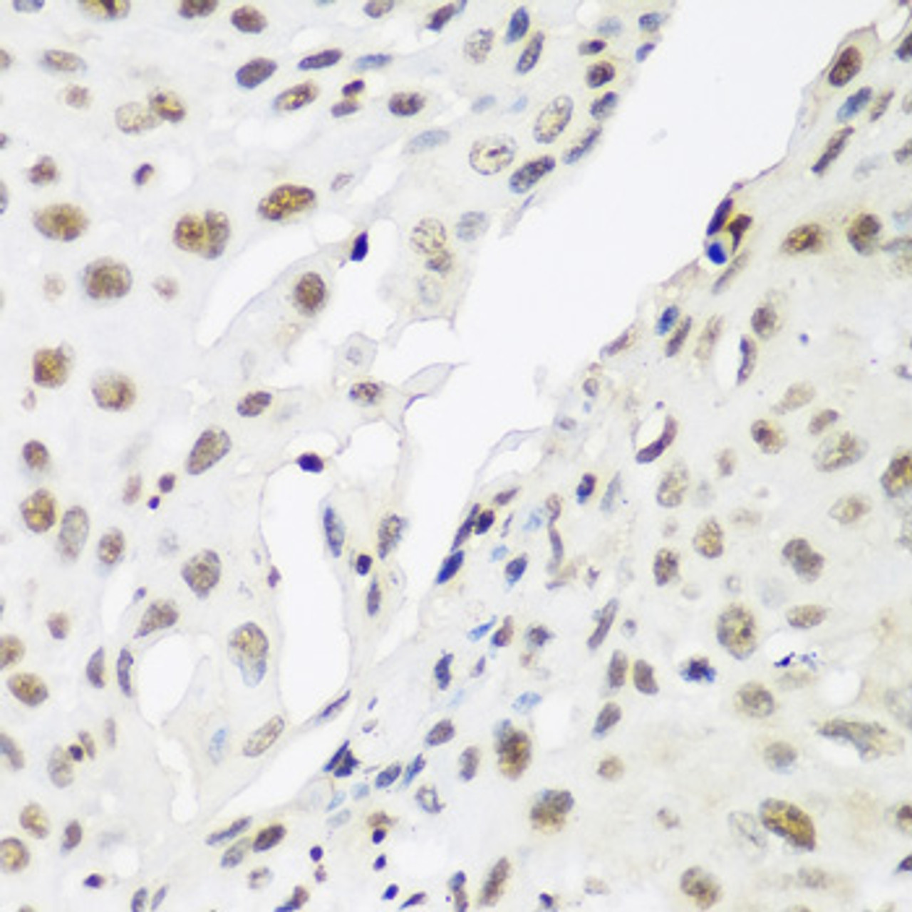 Immunohistochemistry of paraffin-embedded Human lung cancer using CBX3 Polyclonal Antibody at dilution of  1:200 (40x lens).